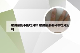 银屑病能不能吃河蚌 银屑病患者可以吃河鱼吗