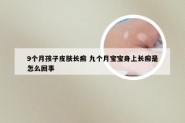 9个月孩子皮肤长癣 九个月宝宝身上长癣是怎么回事