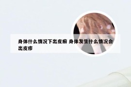 身体什么情况下出皮癣 身体发生什么情况会出皮疹