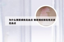 为什么银屑病有出血点 银屑病皮肤出现点状出血点