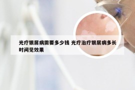 光疗银屑病需要多少钱 光疗治疗银屑病多长时间见效果