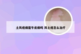 土风疮病是牛皮癣吗 风土疮怎么治疗