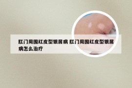 肛门周围红皮型银屑病 肛门周围红皮型银屑病怎么治疗