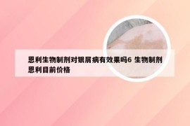 恩利生物制剂对银屑病有效果吗6 生物制剂恩利目前价格