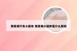 银屑病只有小腿有 银屑病小腿肿是什么原因