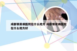 成都银屑病医院在什么地方 成都银屑病医院在什么地方好