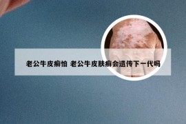 老公牛皮癣怕 老公牛皮肤癣会遗传下一代吗