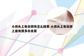 小孩头上有白斑块怎么回事 小孩头上有白斑上面有很多白皮屑