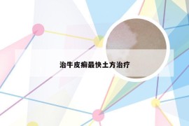 治牛皮癣最快土方治疗