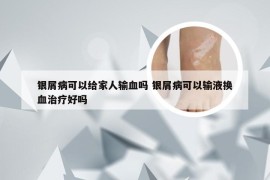 银屑病可以给家人输血吗 银屑病可以输液换血治疗好吗