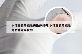 小孩患银屑病激光治疗好吗 小孩患银屑病激光治疗好吗视频