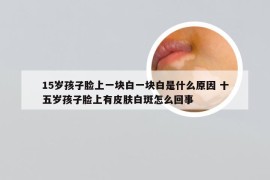 15岁孩子脸上一块白一块白是什么原因 十五岁孩子脸上有皮肤白斑怎么回事