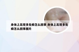 身体上出现多处癣怎么回事 身体上出现多处癣怎么回事图片