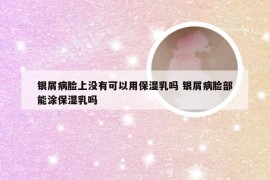 银屑病脸上没有可以用保湿乳吗 银屑病脸部能涂保湿乳吗