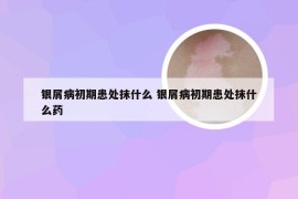 银屑病初期患处抹什么 银屑病初期患处抹什么药