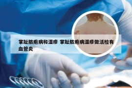 掌趾脓疱病和湿疹 掌趾脓疱病湿疹做活检有血管炎