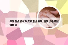 寻常型点滴状牛皮癣愈合表现 点滴状寻常型银屑病