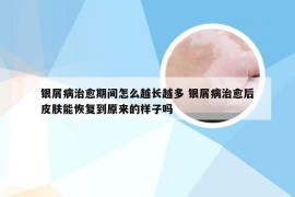 银屑病治愈期间怎么越长越多 银屑病治愈后皮肤能恢复到原来的样子吗