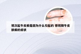 初次起牛皮癣是因为什么引起的 得初期牛皮肤癣的症状