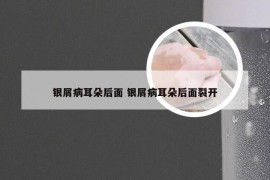 银屑病耳朵后面 银屑病耳朵后面裂开