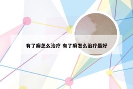 有了癣怎么治疗 有了癣怎么治疗最好