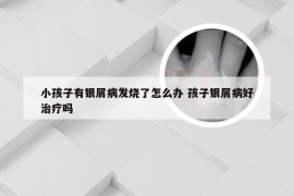 小孩子有银屑病发烧了怎么办 孩子银屑病好治疗吗