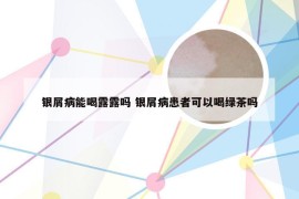 银屑病能喝露露吗 银屑病患者可以喝绿茶吗