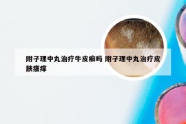 附子理中丸治疗牛皮癣吗 附子理中丸治疗皮肤瘙痒