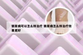 银屑病可以怎么样治疗 银屑病怎么样治疗效果更好