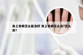 身上有癣怎么能治好 身上有癣怎么治?怎么弄?