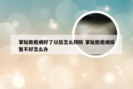 掌趾脓疱病好了以后怎么预防 掌趾脓疱病反复不好怎么办