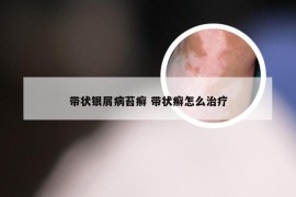 带状银屑病苔癣 带状癣怎么治疗