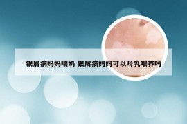 银屑病妈妈喂奶 银屑病妈妈可以母乳喂养吗