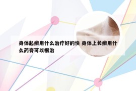 身体起癣用什么治疗好的快 身体上长癣用什么药膏可以根治