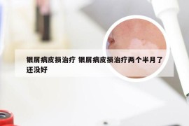 银屑病皮损治疗 银屑病皮损治疗两个半月了还没好