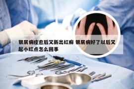 银屑病痊愈后又新出红癣 银屑病好了以后又起小红点怎么回事