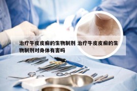 治疗牛皮皮癣的生物制剂 治疗牛皮皮癣的生物制剂对身体有害吗