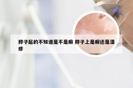 脖子起的不知道是不是癣 脖子上是癣还是湿疹