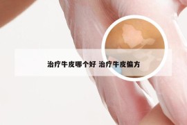 治疗牛皮哪个好 治疗牛皮偏方