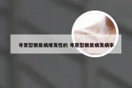 寻常型银屑病爆发性的 寻常型银屑病发病率