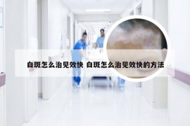 白斑怎么治见效快 白斑怎么治见效快的方法