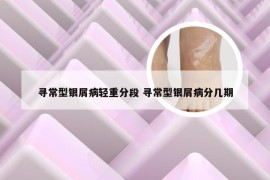 寻常型银屑病轻重分段 寻常型银屑病分几期