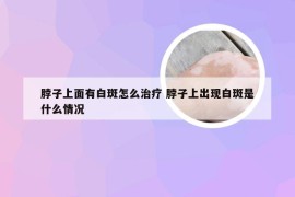 脖子上面有白斑怎么治疗 脖子上出现白斑是什么情况