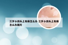 三岁小孩头上有癣怎么办 三岁小孩头上有癣怎么办图片