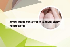 关节型银屑病怎样治才能好 关节型银屑病怎样治才能好呢