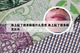 身上起了很多癣是什么意思 身上起了很多癣怎么办