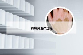 白癜风治疗过程