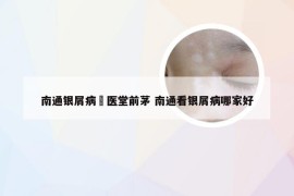 南通银屑病崋医堂前茅 南通看银屑病哪家好