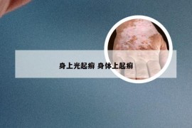 身上光起癣 身体上起癣