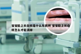 宝宝脸上长白班是什么东西啊 宝宝脸上长白斑怎么才能消掉